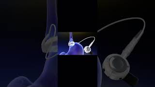 Lap-Band procedure overview