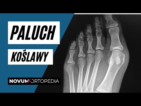 Wideo: Leczenie Palucha Koślawego