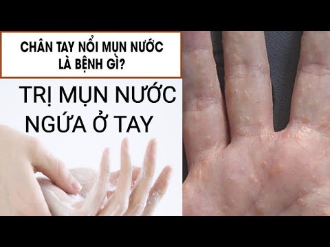 chữa mụn nước ngứa ở tay, chữa mụn nước, chữa mụn ngứa ở tay, phương pháp 2#?