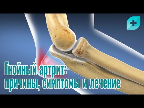 Гнойный артрит: причины, симптомы и лечение