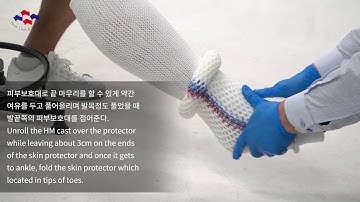HM Cast procedure Short leg