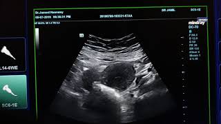Abdominal Wall Endometriosis  Sonography
