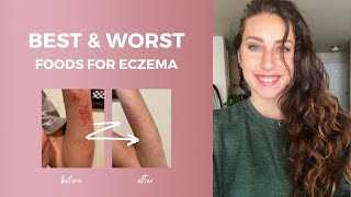 ECZEMA Foods to Eat & Avoid // Michelle Mills