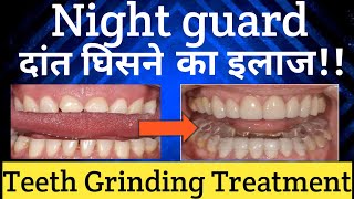 Night Guard For Teeth Grinding live Demo |दांत घिसने का इलाज |Bruxism |Teeth Grinding Treatment screenshot 1