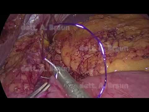 Redo-surgery: gastric bypass su sleeve gastrectomy