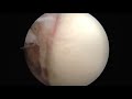 Arthroscopic Latarjet Procedure Combined With Bankart Repair A Technique Using 2 Cortical Buttons an