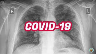 Chest X-rays findings in COVID-19 patients by Amos 9,226 views 3 years ago 8 minutes, 8 seconds