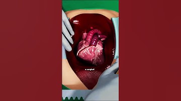 Heart Bypass Surgery 3D Animation (CABG) #nocad #angioplasty #rightheartcatheterization #cathlab