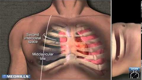 Needle Decompression Insertion Site Tutorial by Medrills