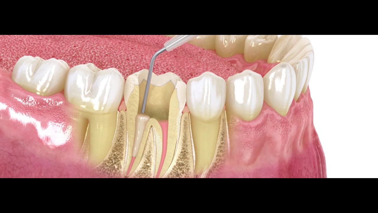 MIXPAC Colibri - Post Cementation