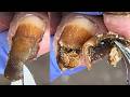 The Entire Toenail Is Yellowish Black; Remove The Affected Parts【Xue Yidao】