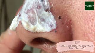 BioFormula Select: Here’s Exactly How Kaolin Clay Removes Blackheads