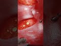 Как удаляют миндалины? #биология #медицина