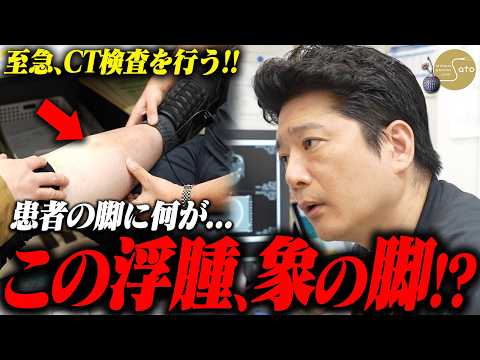 【衝撃】『見たことのない浮腫！ゾウの脚！？』突如患者を襲った脚のむくみ… 至急CT検査を決意した医師、その結果はリンパ浮腫が原因だった！？
