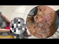 😱🦶 Jigger Gigante Extraído – Limpeza Completa dos Pés! #BW018
