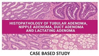 Histopathology of Tubular, Nipple, Lactating & Ductal Adenomas – Case-Based Insights