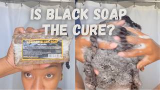Sebhorrheic Dermatitis and Black Soap