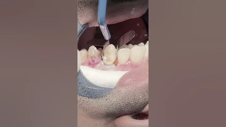 Composite veneer to all upper anterior teeth #dentist