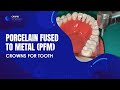 Porcelain fused to metal pfm crowns for tooth 30  caapid simplified bench prep course