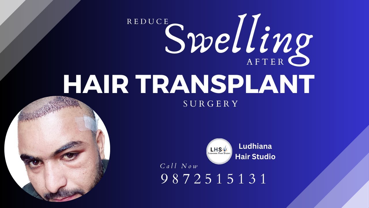 Exercise for Reduce Head Swelling after Hair Transplant - YouTube