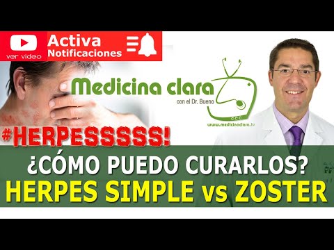 Vídeo: Com tractar l'herpes zòster (Herpes Zoster): 15 passos (amb imatges)