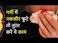 Summer में Nosebleed आम, क्यों आता है नाक से खून? नकसीर फूटने पर तुरंत क्या करें, डॉक्टर ने बताया