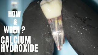 When and How to use Calcium hydroxide in Endodontics  Various ways to use  Waldent Calcium hydroxid