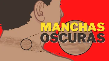 ¿Qué significa una mancha oscura en el pecho?