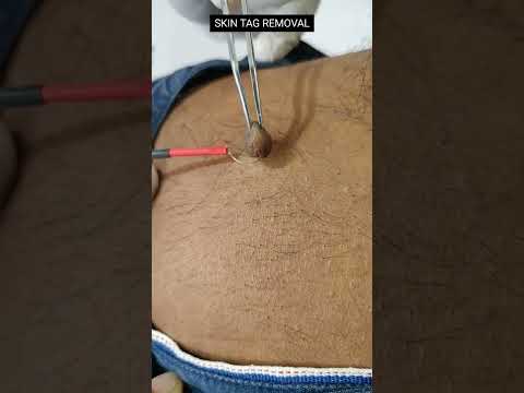 skin tag removal (painless)#skincare #skintags #cosmetics