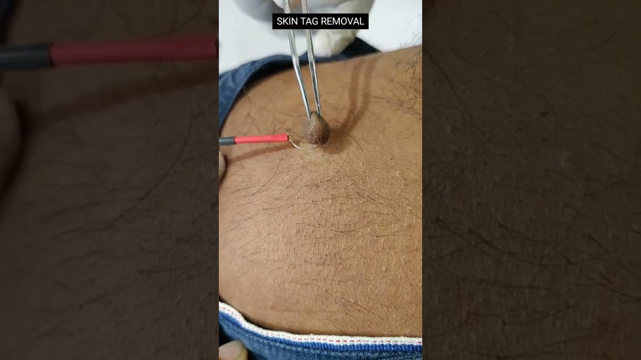 Skin Tag Removal Painless Skincare Skintags Cosmetics