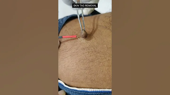 skin tag removal (painless)#skincare #skintags #cosmetics