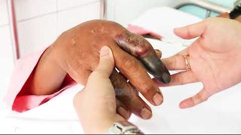 Bệnh nhân bị rắn hổ mang chúa cắn hoại tử ngón tay