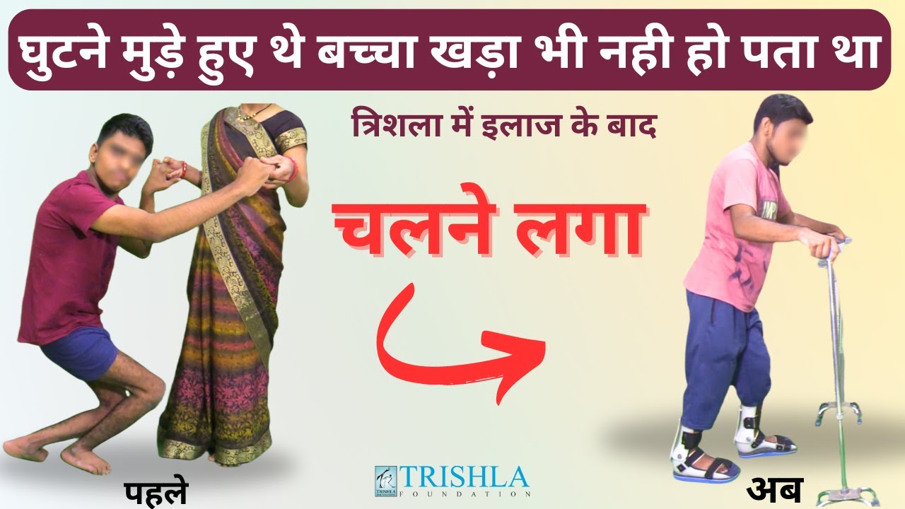 मेरा सेरेब्रल पाल्सी से प्रभावित बच्चा अब चल पा रहा है | Crouch Gait Pediatrics | Trishla foundation