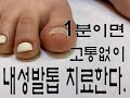 1분이면 내성발톱 치료가능