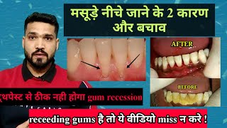 मसूड़े नीचे जाने के 2 कारण और बचाव  Gum recession 2 causes & prevention