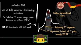 Lad Occlusion On Ecg In Lead V2-V4.
