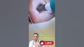 Cera GIGANTE do OUVIDO!