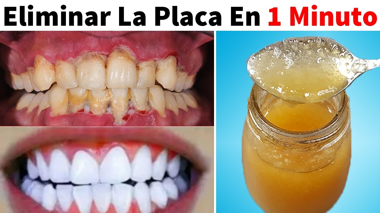 Blanqueamiento dientes natural