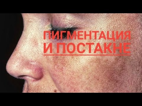 АПТЕЧНАЯ ТРАВА ОТ ПИГМЕНТАЦИИ. Пигментация и Постакне. Гомеопатия от пигментации.