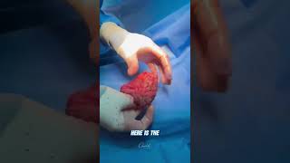 Capsular Contracture: I Wanna Look Away, but I Can't👀 by Cassileth Plastic Surgery and Skin Care 226 views 1 month ago 1 minute, 17 seconds