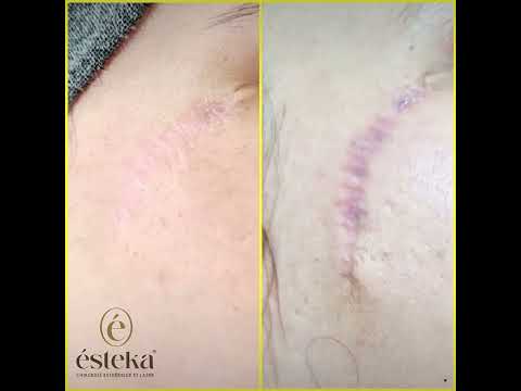 ليزر نزع الآثار الدكتور تواتيت زكريا جراحة التجميل والحروق 0540898774