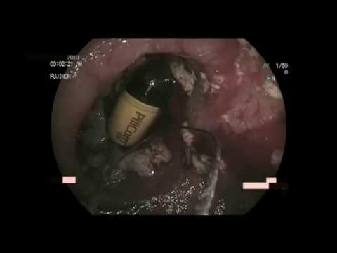 RESCUE OF RETAINED VIDEO CAPSULE USING DBE