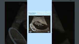 How To predict Boy baby in Scan report Part 2   Ramzi theory Shorts  Baby and Mother care