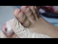 Ep_3148 Ingrown toenail removal 👣 ออกแล้ว! พี่เอาออกง่ายจัง 😷 (This clip is from Thailand)