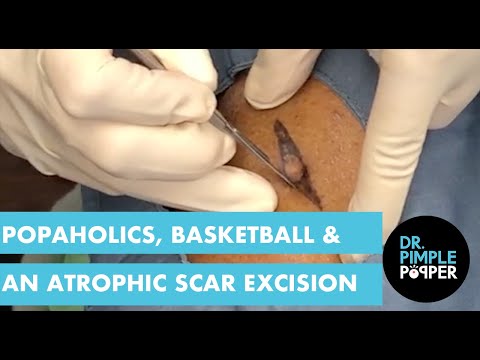 Popaholics, Basketball, and an Atrophic Scar Excision - Popaholics, Basketball, and an Atrophic Scar Excision