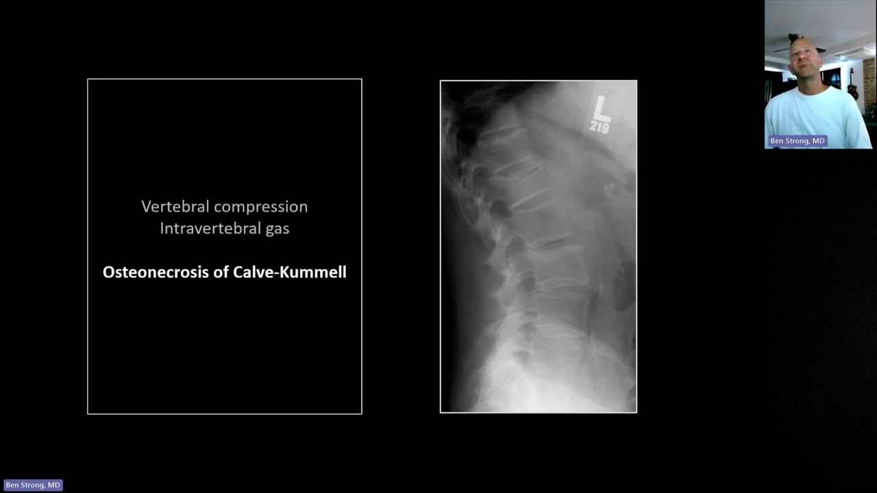 Fractures of the Thoracolumbar Spine and Shoulder | Free Radiology CME