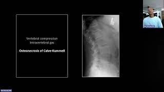 Fractures of the Thoracolumbar Spine and Shoulder | Free Radiology CME