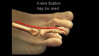 End to End (Mild to moderate hammertoe correction surgery)