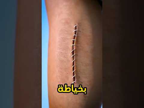 كيف يلتئم الجرح  
