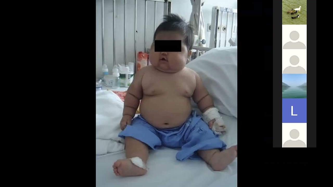 MRCPCH - 57. CUSHING'S SYNDROME VIDEO STATION